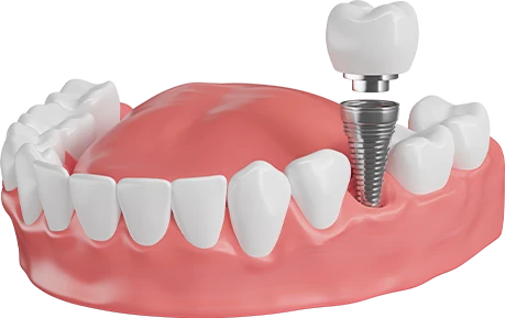 Best Dental Implants in Jaipur