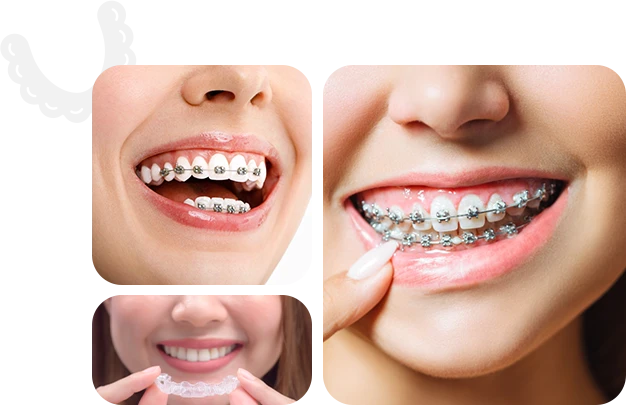 Best Invisalign Braces Near Me